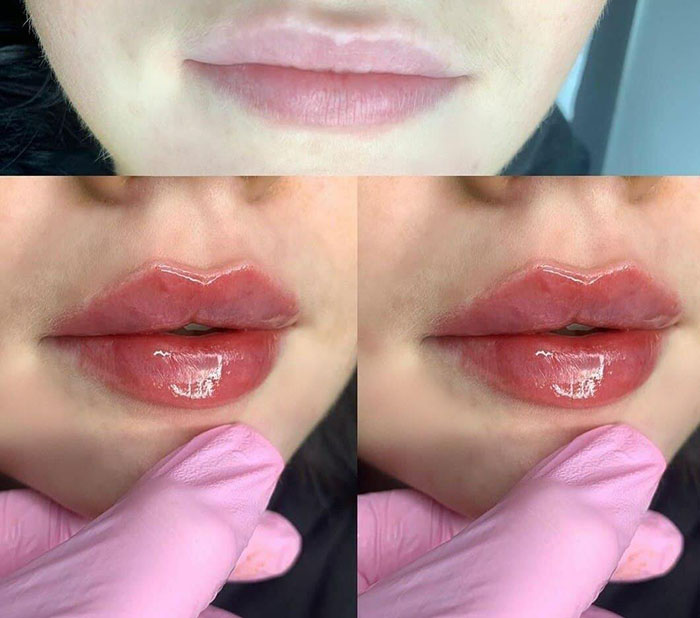 аугментация губ фото до и после