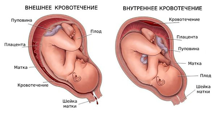 гематома при беременности 