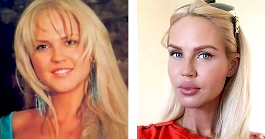 Мария Погребняк до и после увеличения губ