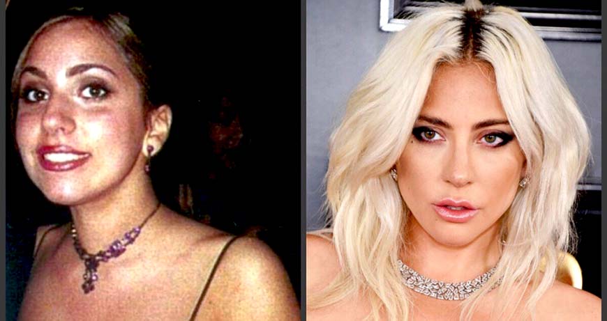Леди Гага: до и после ментопластики