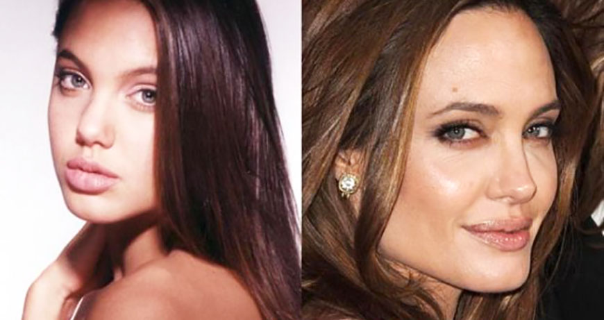 Анджелина Джоли: до и после ментопластики