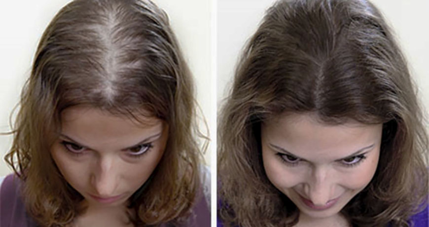 Результаты мезотерапии для волос: фото до и после