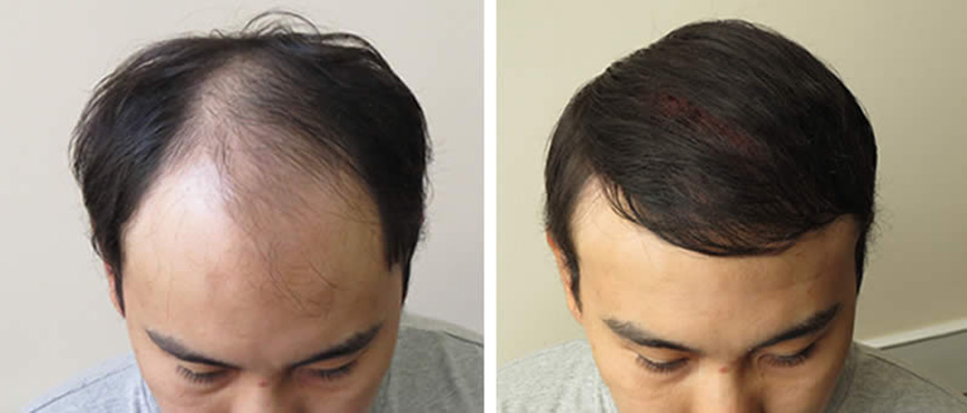 Пересадка волос до и после
