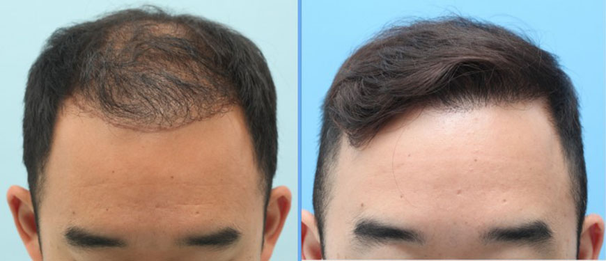 Фото до и после пересадки волос