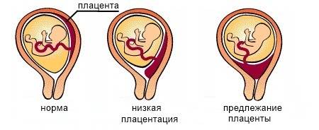 Плацентация при беременности