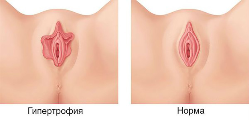 Гипертрофия малых половых губ