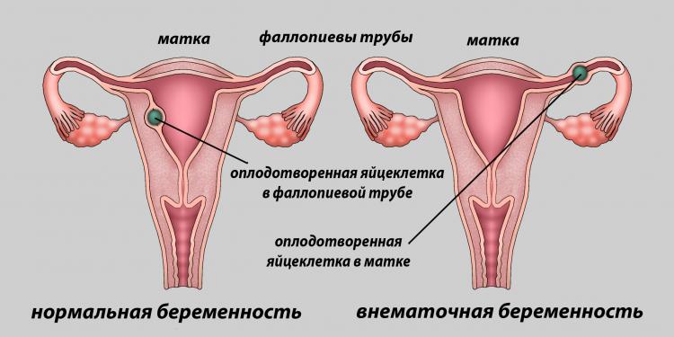 Как возникает внематочная беременность