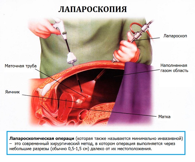 Лапароскопия при внематочной беременности
