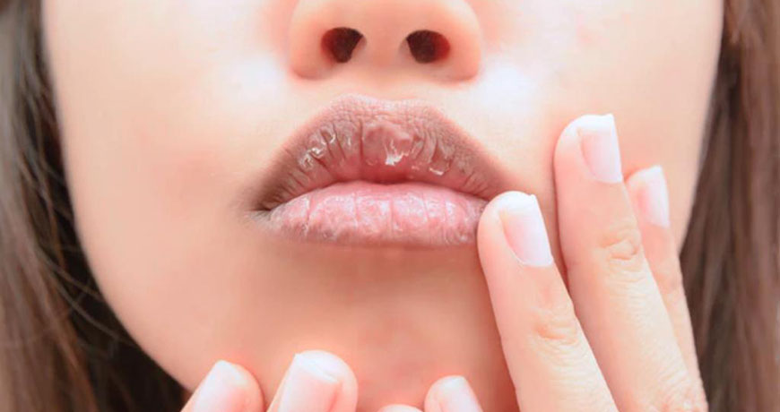 Сухость губ можно исправить филлерами с гиалуроновой кислотой